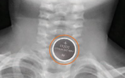 Button Batteries – the Dangers Persist